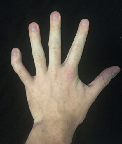 skauda viduriniosios piršto sąnarys ant rankos kai lankstant
