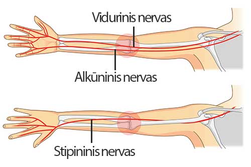 kaip nustatyti sąnarių artritas ar gali būti rankas nuo artrito