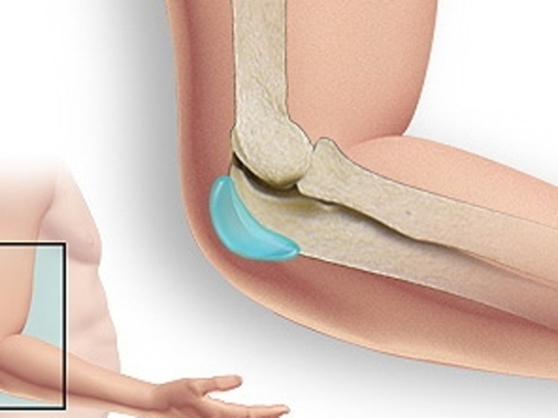 skysčio kaupimasis alkūnės sąnario gydymo ankstyvas artritas piršto sąnarių
